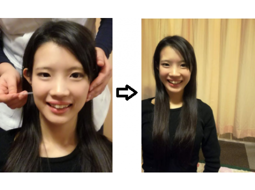 【大阪・中央区】鍼灸で小顔作りを体験しよう♪ 初めてのセットプラン（顔+腕）15~30分コースの画像
