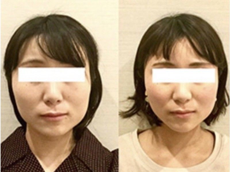 [Nagoya / Meieki Immediate] "Face correction (small face correction, hedgehog beauty acupuncture)" for small face without downtimeの紹介画像